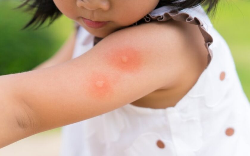 mosquito bite on little girl
